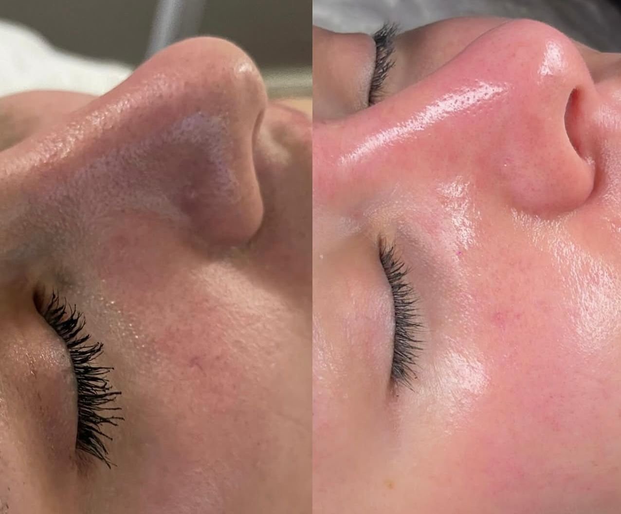 Facial SUMAQ + Booster (Hidratación)